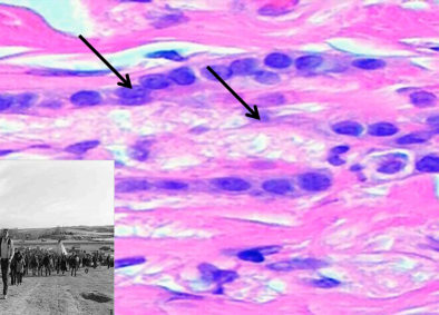 <p>What pathology and what pattern in the pointed arrows?</p>