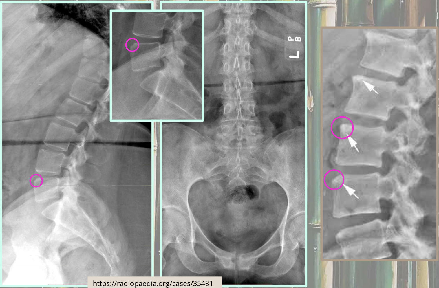 <p>What two findings of AS are found in this image</p>