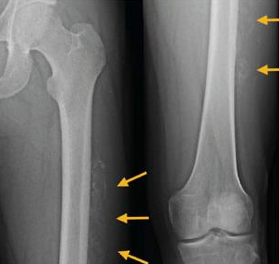 <ul><li><p>POLICE acute injuries</p></li><li><p><span style="color: red;"><strong>Protected weightbearing (Crutches)</strong></span></p></li><li><p>Start with gentle ROM exercises → Isometrics after swelling resolves</p></li><li><p>NSAIDS/corticosteroids for persistent swelling</p><ul><li><p><mark data-color="red" style="background-color: red; color: inherit;">Avoid: heat, massage, premature return to aggressive stretching, strengthening, or return to sport</mark></p></li></ul></li><li><p><span style="color: red;"><strong>Return to activity does not occur until after bony growth subsides</strong></span></p></li></ul><p></p>