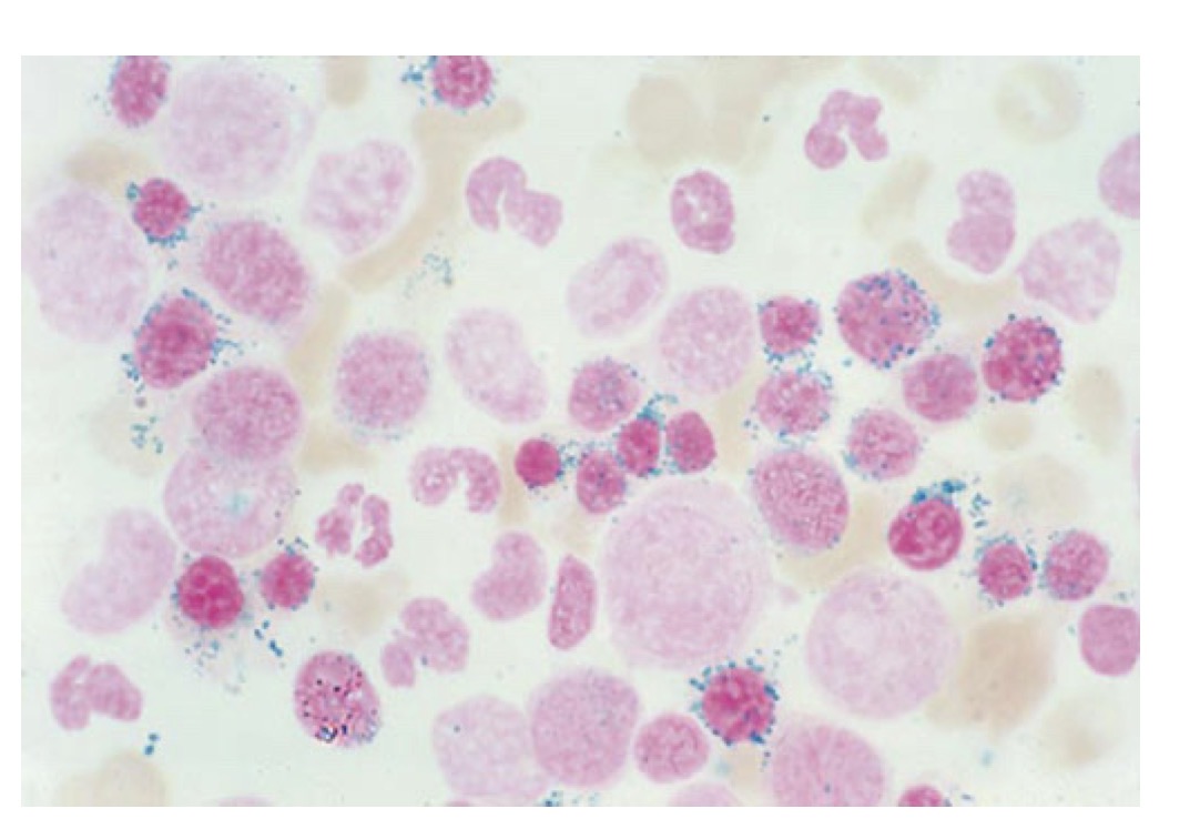 <p>What is sideroblastic anemia</p>