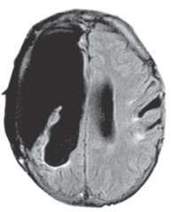 <p>the brain's ability to change, especially during childhood, by reorganizing after damage or by building new pathways based on experience.</p>