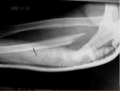 <p>bado 2 monteggia</p>