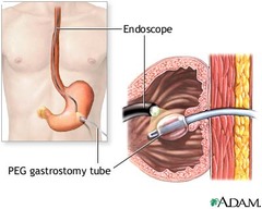 <p>an endoscopic procedure in which a tube is passed into a patient's stomach through the abdominal wall and mostly provides a means of feeding or oral intake</p>