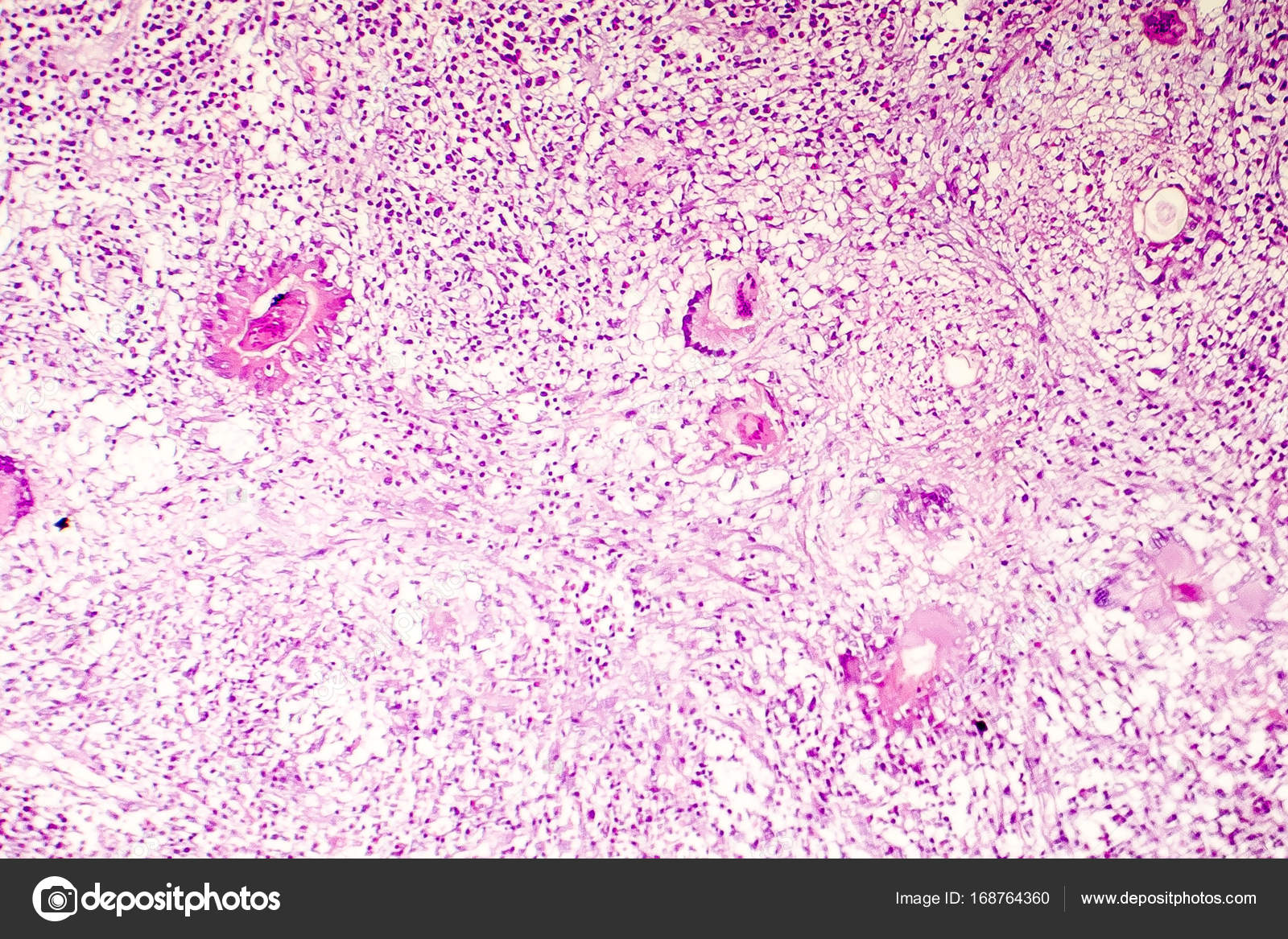 <p><strong>Necrosis Licuefactiva cerebral</strong></p><p>-<span><span>Se caracteriza por la disolución parcial o completa del tejido muerto y su transformación en una masa líquida</span></span></p><p><span><span>-</span></span>En el corte histológico se observa <strong>material eosinófilo amorfo</strong>.</p><ul><li><p><strong>Gran infiltrado de células inflamatorias</strong></p><ul><li><p>Especialmente <strong>neutrófilos</strong>, que liberan enzimas y contribuyen a la digestión.</p></li></ul></li><li><p><strong>Formación de cavidades llenas de líquido o pus</strong></p><ul><li><p>En infecciones puede formarse un <strong>absceso</strong>.</p></li></ul></li></ul><p></p>