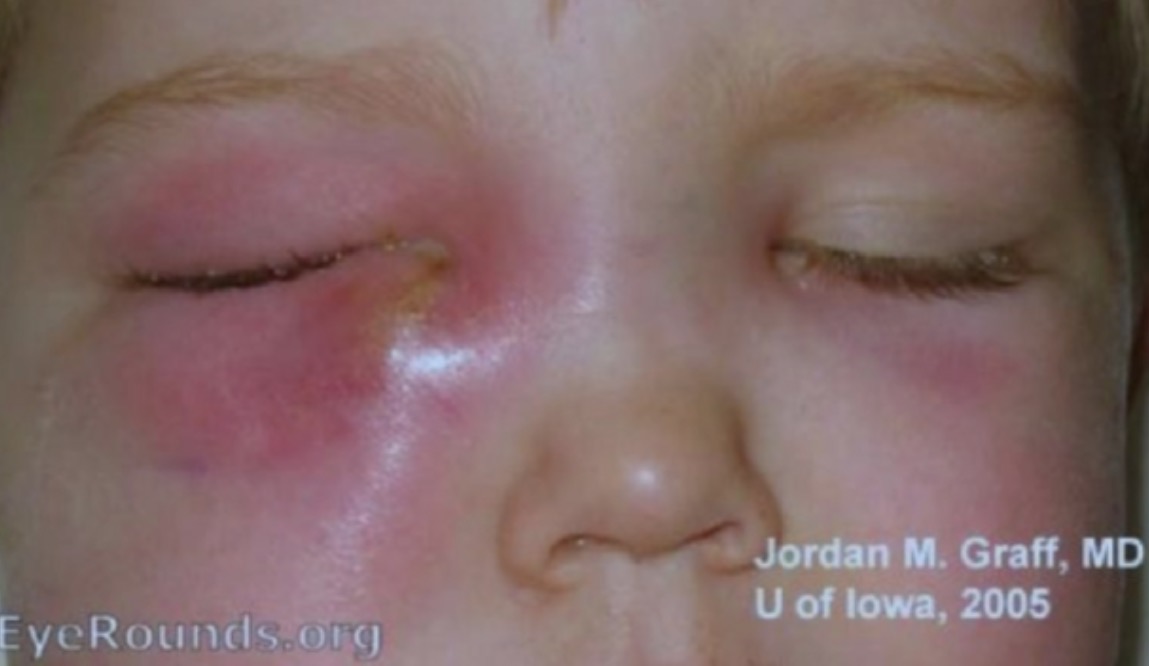 <p><span>Un enfant de 6 ans se présente avec fièvre et céphalées depuis 24 heures. Il a une diminution des mouvements extra-oculaires de l’oeil droit. Lequel des énoncés suivants est VRAI ?</span></p><p><span>A. Il s'agit probablement d'une conjonctivite bactérienne</span></p><p><span>B. Le traitement de choix est corticostéroïdes systémiques à hautes doses</span></p><p><span>C. On doit le traiter avec des antibiotiques intra-veineux</span></p><p><span>D. On doit le traiter avec un onguent antibiotique topique et le revoir dans 7 jours</span></p><p><span>E. La tomodensitométrie de l'orbite et des sinus est très rarement requise</span></p>