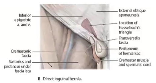 <p>direct inguinal hernia </p>