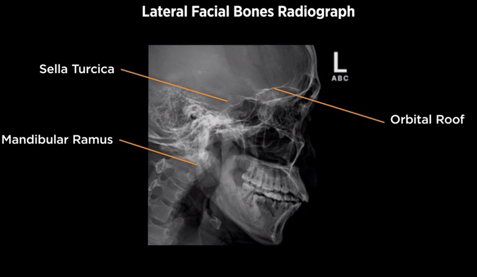 <p>Lateral Facial Bones</p>