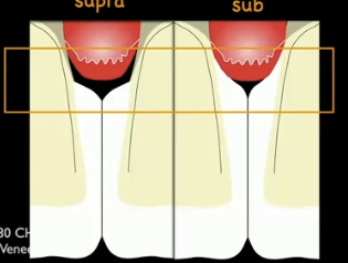 <p>What are some indications for subgingival finish lines?</p>
