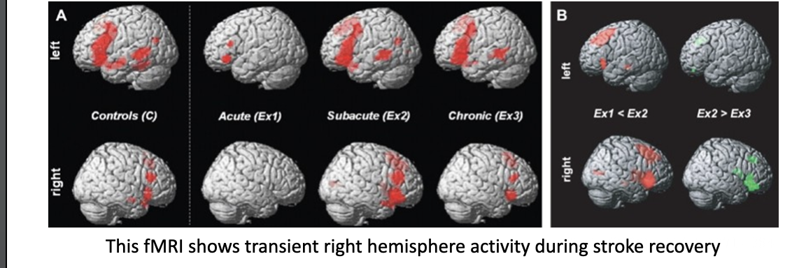 <p>This fMRI shows transient right hemisphere activity during stroke recovery</p>