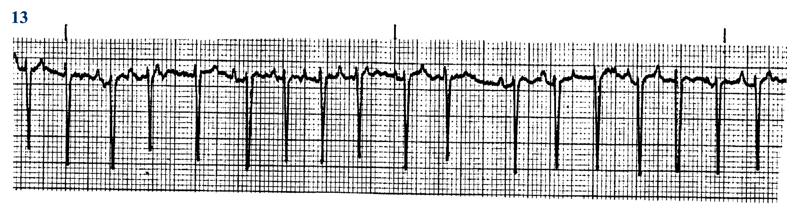 <p>WHat ECG is this? </p>