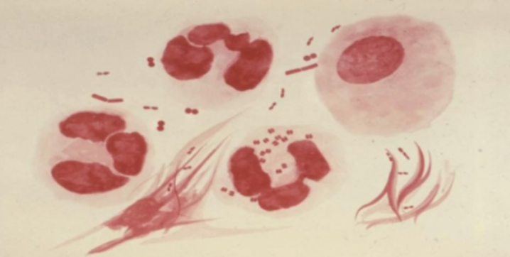 <p>⚠️67.The gold standard for the diagnosis of this gram (-) intracellular diplococci is: A.Sabouraud’s medium B.Saline wet mount C.Dark-field microscopy D.Thayer-martin culture</p>