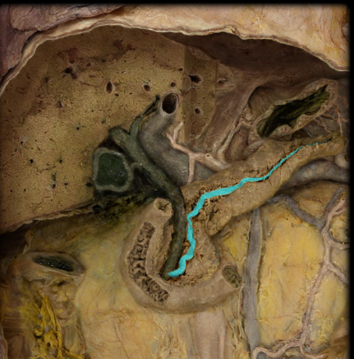 <p>runs the length of the pancreas to join the common bile duct at the duodenum, pancreatic juice leaves via this</p>