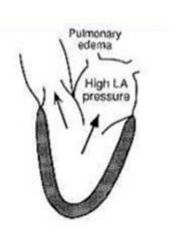 <ul><li><p>no time for adaptation</p></li><li><p>LV, LA dilation → acute pulmonary oedema, cardiogenic shock</p></li></ul><p></p>