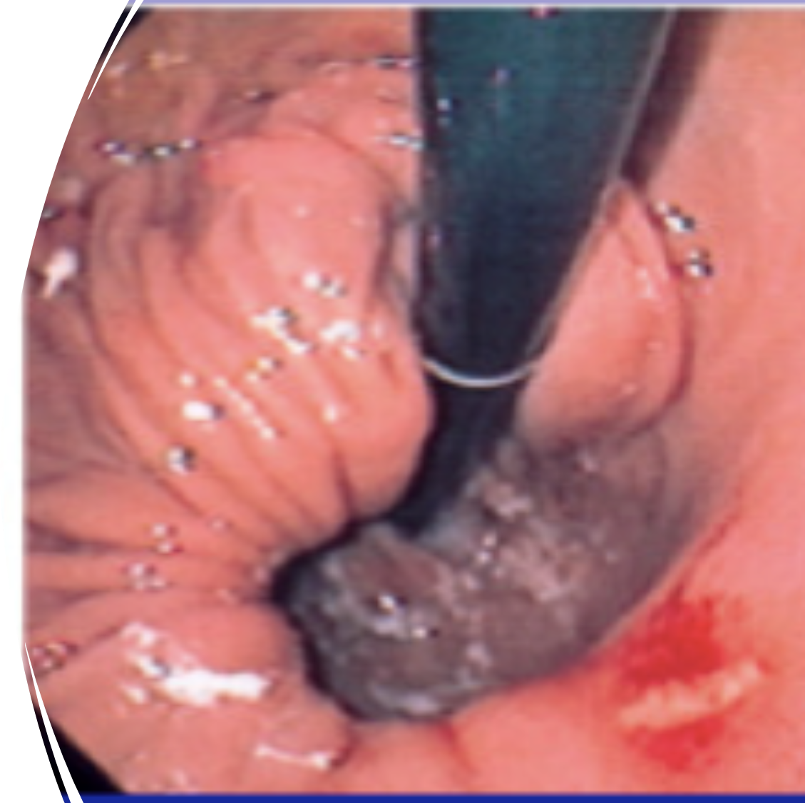 <p>linear erosion in a hiatal hernia</p><p>chronic or acute bleeding</p><p>painless</p>