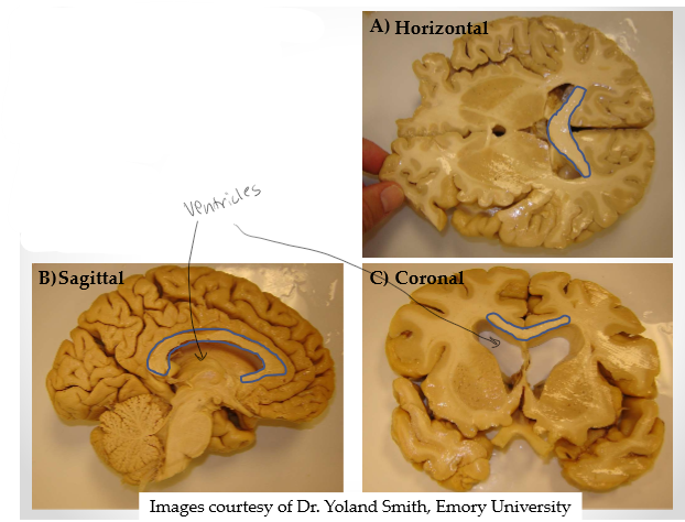 <p>Spaces are lateral ventricles</p>