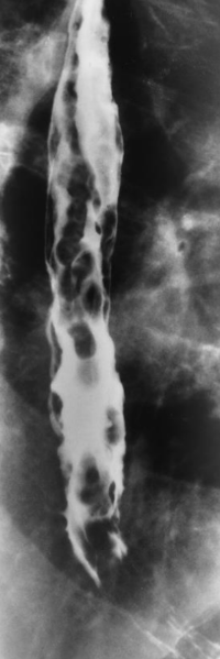 <p>Dilation of the veins in the wall of the distal esophagus; often asymptomatic until bleeding occurs.</p>