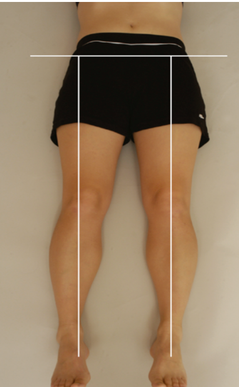 <p><strong>Purpose:</strong></p><ul><li><p><span style="color: red;"><strong>Hip abductor muscle tightness or contracture</strong></span>, primarily gluteus medius and gluteus minimus<span style="color: red;"><strong> - MLT</strong></span></p></li></ul><p></p><p class="isSelectedEnd"><strong>How to Perform:</strong></p><ol><li><p>Pt supine with ASISs level and balanced pelvis</p></li><li><p>Examiner passively adducts the test leg while monitoring pelvic motion</p></li><li><p>Normal hip adducts about 30° before ASIS moves</p></li></ol><p></p><p class="isSelectedEnd"><strong>Positive Test:</strong></p><ul><li><p><span style="color: red;"><strong>ASIS shifts before 30° of adduction and muscle stretch end feel</strong></span></p></li><li><p><span style="color: red;"><strong>Affected leg forms >90° angle with line joining ASISs</strong></span></p></li><li><p><span style="color: red;"><strong>When attempting to rebalance the pelvis, the ASIS shifts downward on the affected side or upward on the opposite side, making pelvic alignment difficult</strong></span></p></li></ul><p></p><p><strong>Interpretation:</strong> Abductor contracture may cause functional/apparent limb lengthening and contribute to pelvic asymmetry or altered gait mechanics</p>