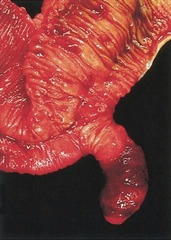 <p>outpouching of distal ileum</p>