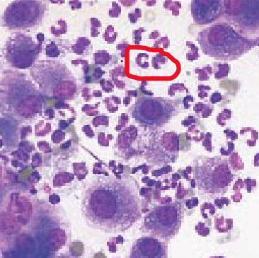 <ul><li><p>significant number of macrophages (circled red) present</p></li><li><p>Fungal or parasitic infections manifest this way</p></li></ul><p></p>