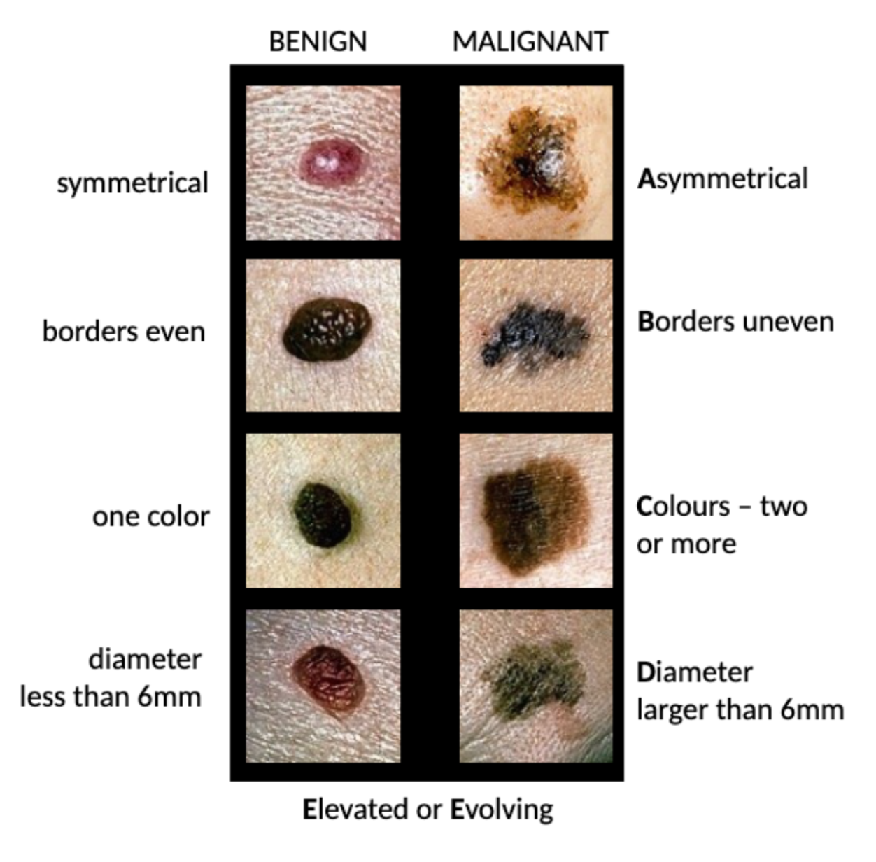 <p>Asymmetry</p><p>Border (irregular)</p><p>Colour (multiple/uneven)</p><p>Diameter (>6 mm)</p><p>Evolving/elevation</p>