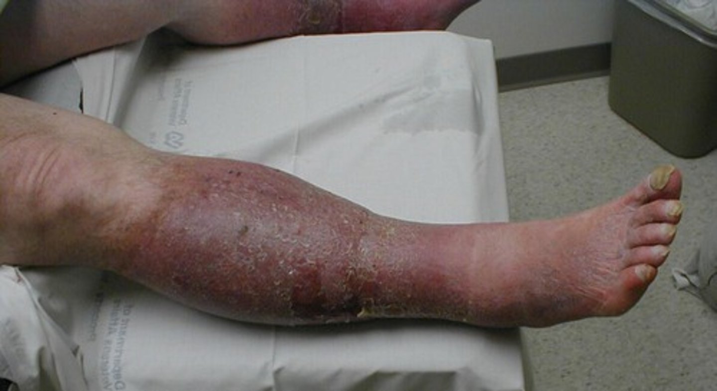 <p>not getting enough arterial blood flow = ischemic pain, usually happens on one leg, leg appears shiny, hairless, red/blue then pallor, limb gets cool, pain gets better when resting since the limb doesn't need as much O2 blood flow (intermittent claudication), gravity works for it when legs are down, causes impotence in males, can affect nails/toes</p>