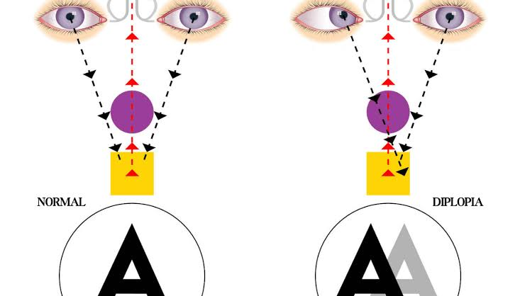 <p>Double vision</p>