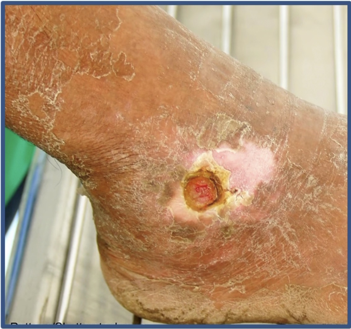 <p>Is this a venous or arterial ulcer?</p>