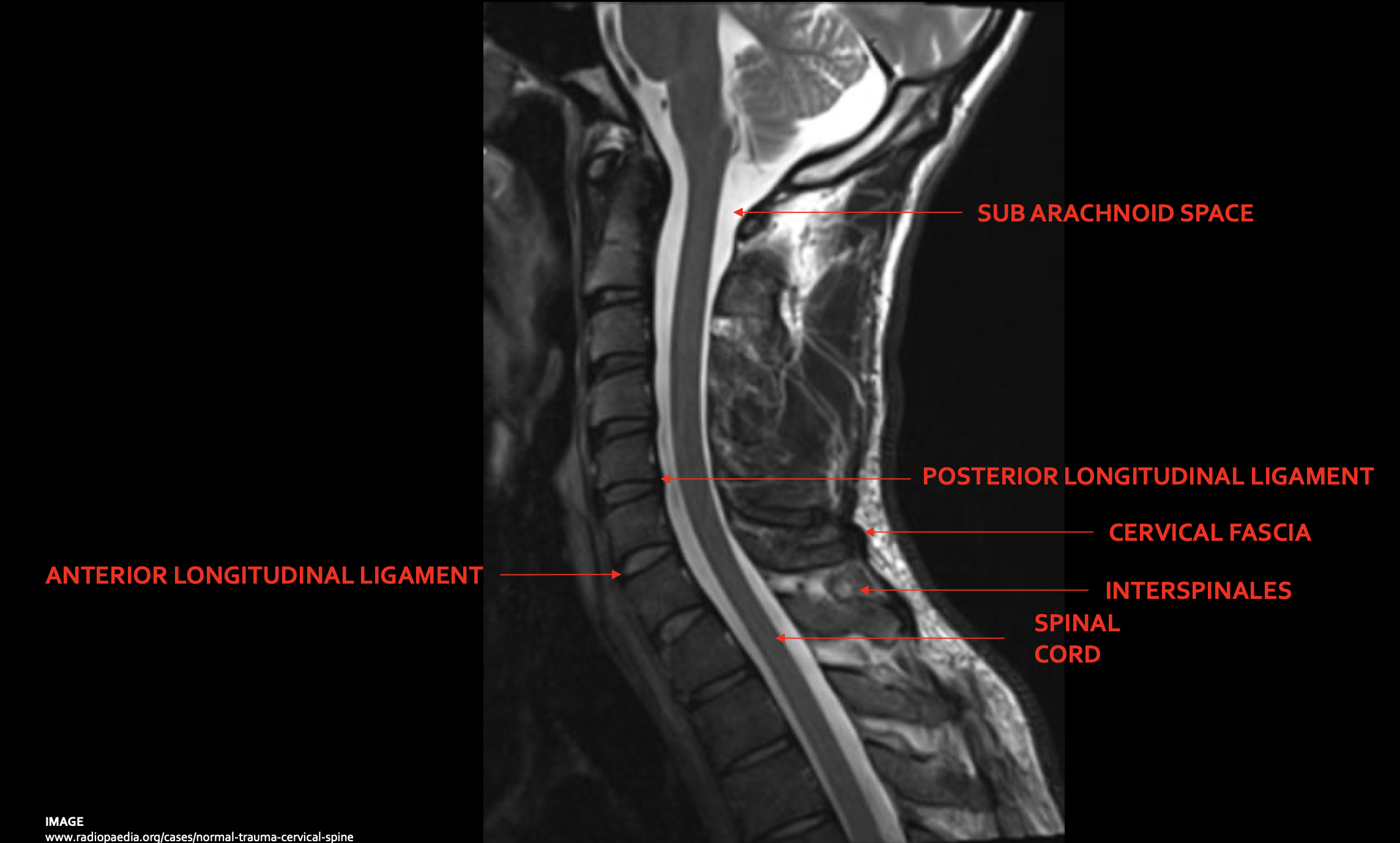 <p><span>Posterior longitudinal ligament (PLL)</span></p>