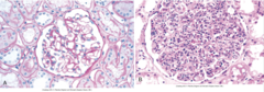 <p>-steptococcus pyogenes</p><p>-immune complexes (activate inflammation, causes proliferation)</p><p>-most common in children</p><p>-causes inflammation & hypercellularity</p>