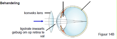 <ol><li><p>Bril met Konvekselense: Konvekse lense breek die ligstrale meer voordat dit die oog binne gaan</p></li><li><p>Laserchirurgie: Kornea weefsel word verdik en meer rond gemaak</p></li></ol><p></p><p></p>
