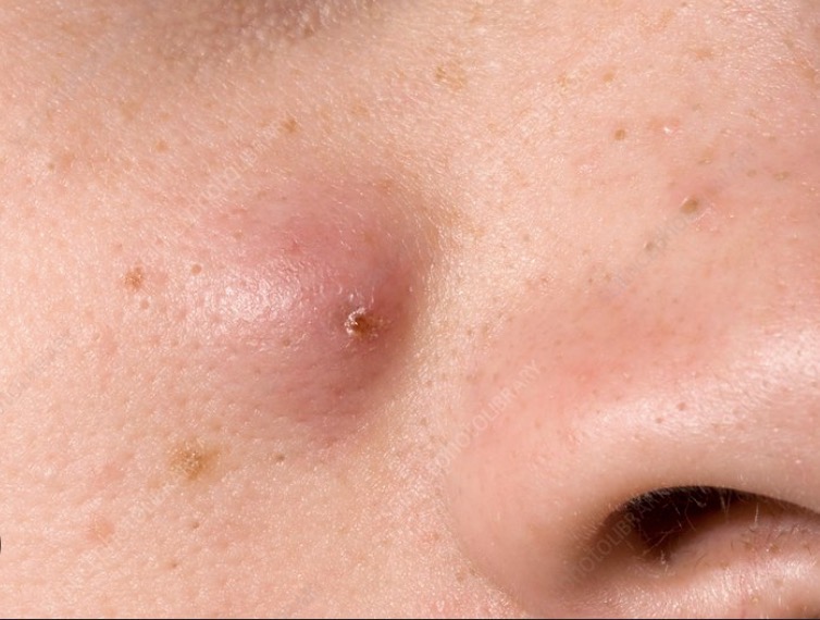 <ul><li><p>Primary skin lesion</p></li><li><p>solid</p></li><li><p>Hard</p></li><li><p>>1cm</p></li></ul><p></p>