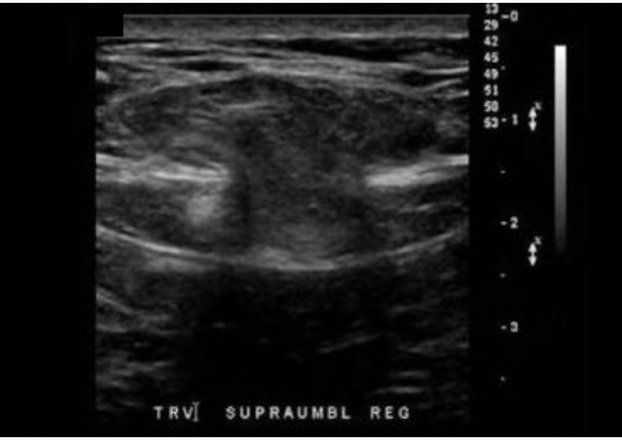 <p>A 50yr old male presents with paraumbilical pain and a palpable mass. The findings on the image are most suggestive of:</p><p>A. A large rectus sheath lipoma</p><p class="p1">B. A large rectus sheath hematoma</p><p class="p1">C. Abdominal wall hernia with no bowel protrusion</p><p class="p1">D. Abdominal wall hernia with bowel protrusion</p>