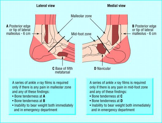 <p>If there is bone tenderness at the <strong>posterior/tip</strong> of the <strong>lateral</strong> or <strong>medial malleolus</strong></p>