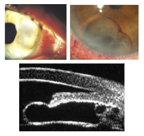 <p>What is the most likely diagnosis ?</p>