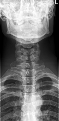 <p><span>Evaluate the AP Axial C-spine radiograph below and select any of the statements that are true (multiple answers possible):</span></p><ol><li><p><span>Not all required vertebrae are demonstrated</span></p></li><li><p><span>There is excessive extension of the head/neck</span></p></li><li><p><span>The R/L marker is incorrect</span></p></li><li><p><span>This is a well-positioned radiograph; no repeat required.</span></p></li></ol><p></p>