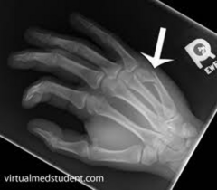 <p>- Fx of the 4th &/or 5th metacarpal (most often the neck)</p><p>- Results from a direct blow with a closed fist (striking a hard surface—ie: a concrete wall)</p>