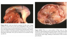 <p>Ovarian cyst that forms when the peritoneum becomes embedded in the ovulation fossa</p><p>*Mare excessively hemorrhages into follicular lumen</p>