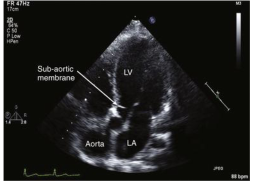 <ul><li><p>fibrous membrane or muscular ring in LVOT → obstruction in the outflow</p></li><li><p><strong>Leads to: </strong>narrow LVOT → septal hypertrophy = thicker IVS → dynamic obstruction → mitral valve may get “sucked up”</p><ul><li><p>dynamic because degree of stenosis varies depending on loading conditions</p></li></ul></li></ul><p></p>