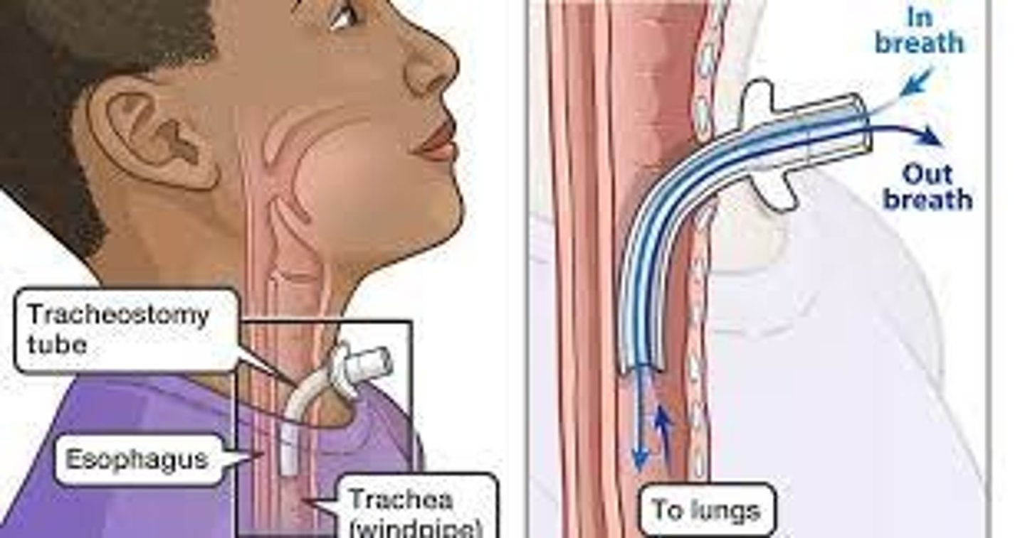<p>breathing tube inserted through neck to trachea</p>