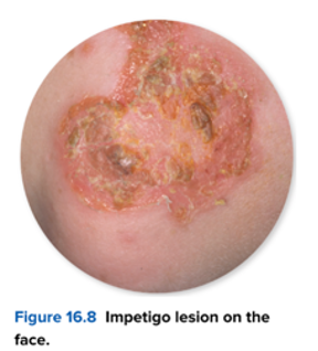 <p><span>Which of the following skin conditions can be prevented through good hygiene practices? Select all that apply</span></p><p><span>❏A. MRSA Skin and Soft-Tissue Infection</span></p><p><span>❏B. Maculopapular Rash Diseases</span></p><p><span>❏C. Impetigo </span></p><p><span>❏D. Cellulitis</span></p>