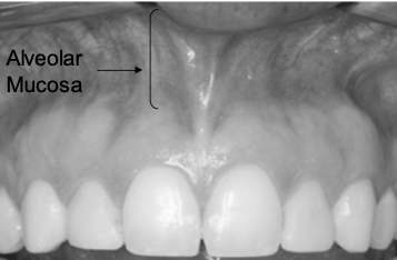 <p>Thin and non-keratinized</p><p class="p1">⢠Predominant connective tissue fibers are elastic, therefore is bound loosely to the underlying bone (permits movement)</p>