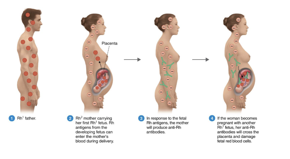 <ul><li><p>Rh<sup>-</sup> mother with an Rh<sup>+</sup> fetus causes the mother to produce anti-Rh antibodies </p></li><li><p>Second Rh<sup>+ </sup>fetus will receive anti-Rh antibodies, damaging fetal RBCs</p></li></ul><p></p>