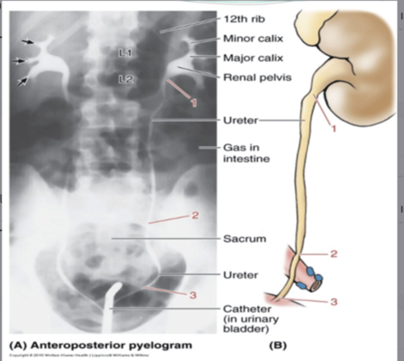 <p>what are constrictions of the ureters?</p>