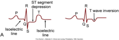<p>D. ST elevation</p>