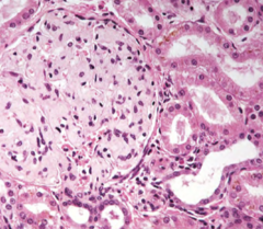 <p>-eosinophilic</p><p>-amorphous</p><p>-looks like "cotton candy"</p>