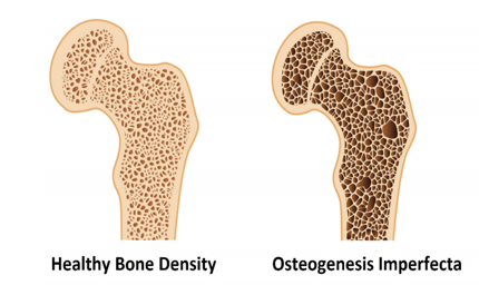 <p>ongenital disorder also known as brittle bone disease that results from a mutation in the collagen gene.</p>