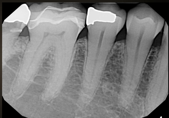<p>what is shown in the non-restored premolar?</p>