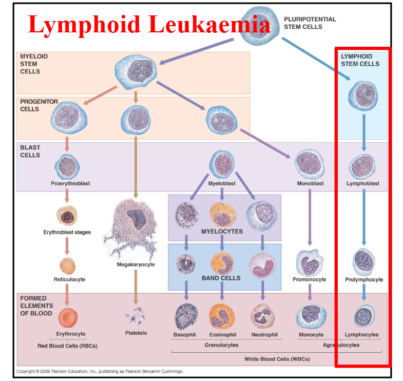 <p>Lymphoid Leukaemia DIAGRAM</p>
