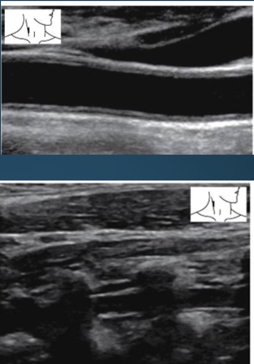 <p>anechoic lumen; thin hyperechoic walls; vertebral arteries course through fossae of transverse vertebra process</p>