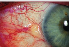 <p>harmless yellowish trangular nodule in bulbar conjunctiva. either side of iris (nasal→temporal)</p><p>RF: aging</p>